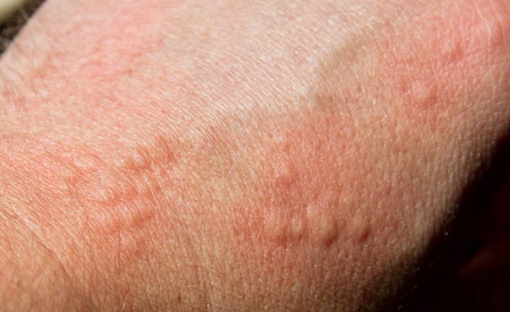 Can Allergy Shots Cure my Chronic Hives