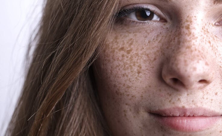 What is Hyperpigmentation And What Can I Do About It?