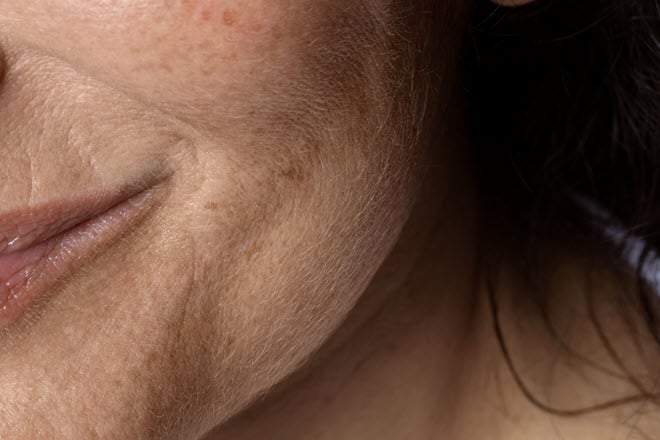 dark spots